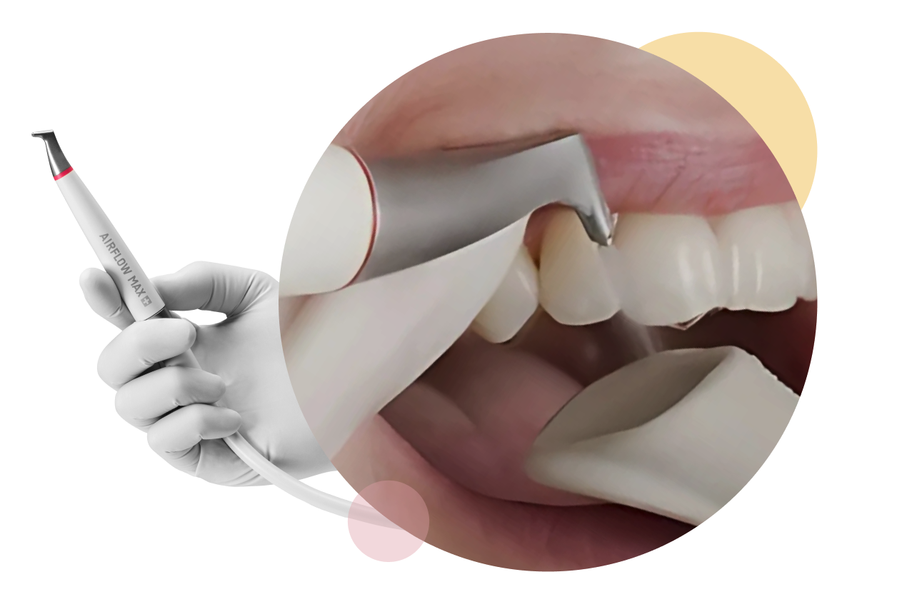 Close-up of the AIRFLOW Prophylaxis Master handpiece being used during a Guided Biofilm Therapy treatment