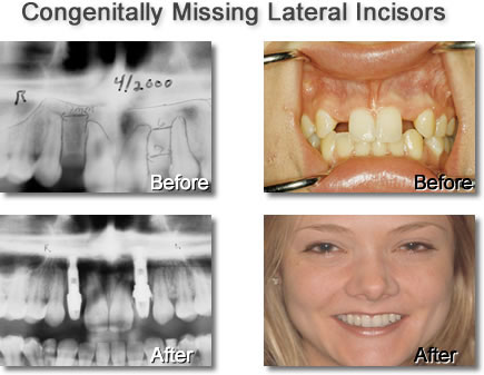 Congenitally Missing Lateral Incisors