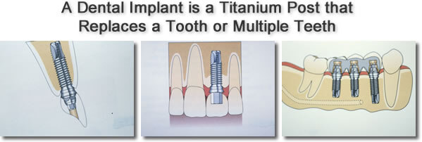 Dental Implants Diagram