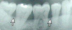 Periodontal Gum Disease X-Ray