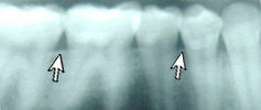 Healthy Gums and Bone X-Ray