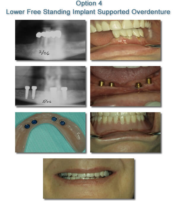 Lower Free Standing Implant Supported Overdenture - Dental Implants