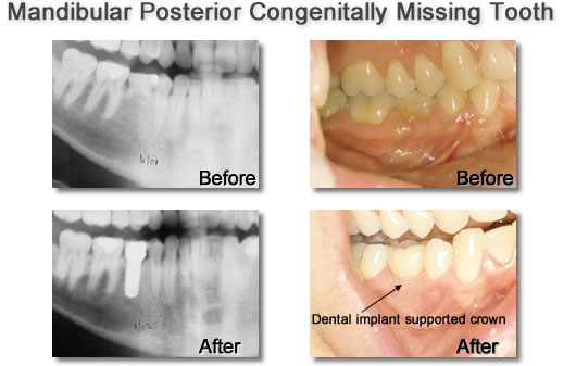 Mandibular Posterior Cong Missing Tooth