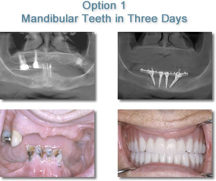 Mandibular Teeth in Three Days - Dental Implants