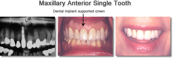 Maxillary Anterior Single Dental Implant Diagram