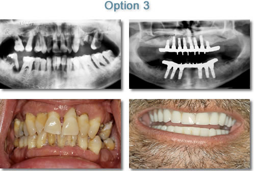 Maxillary & Mandibular Completely Elentulous Fixed Hybrid Prosthesis - Dental Implants