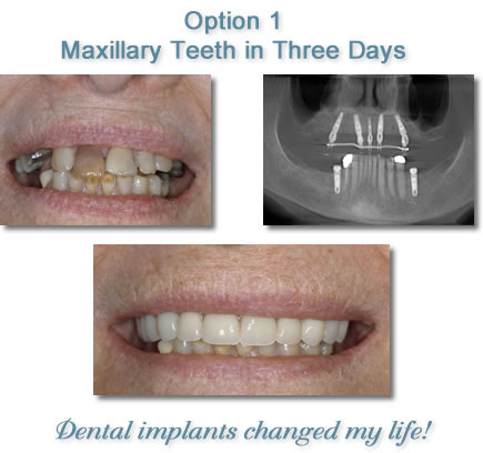 Totally Edentulous Patients - Teeth in Three Days
