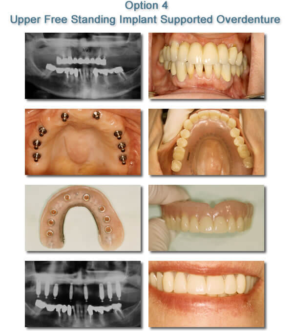Dental Implants - Upper Free Standing Implant Supported Overdenture